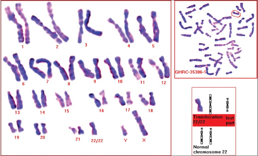 Figure 5: Karyotype of the father(F) showing the balanced homologous chromosomal translocation t (22q;22q), with a metaphase and the partial karyotype