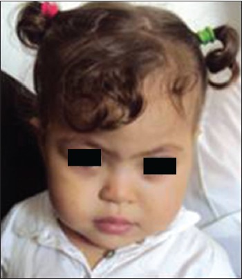 Figure 1: The index propositus having a Down-syndrome like facies