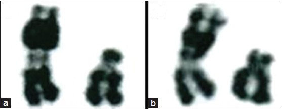 Figure 2: A partial R banding karyotype of the propositus (a) and her mother (b) showing enlarged short arm of one chromosome 22