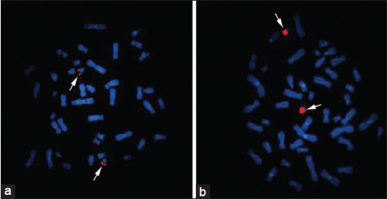 Figure 3: Metaphases hybridized with Down-syndrome critical region probe LSI 21 (a) and whole chromosome paint (WCP) for chromosome 21 (b). (a) LSI showed 2 normal signals at the study locus 21q22.13-q22.2. (b) WCP 22 revealed a complete hybridization of the two long arms of chromosome 21. Neither der 22 nor other chromosomes revealed signal for any of the two probes