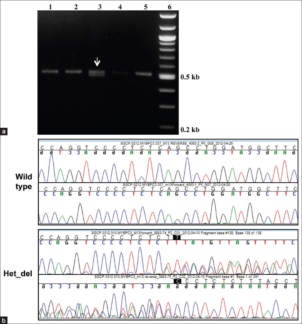 Figure 2: Characterization of the 25 bp deletion in the <i>MYBPC3</i> gene. (a) Representative agarose gel electrophoresis pattern of the PCR products obtained for the wild-type <i>MYBPC3</i> (single band seen in Lanes 1, 2, 4 and 5) and a heterozygous deletion sample (two bands corresponding to the wild-type and the 25 bp deletion seen in Lane 3). The marker lane is shown on the right. (b) Representative sequence chromatogram of a heterozygous sample depicting region of heterozygous deletion (Het_del) in <i>MYBPC3</i> gene viewed as mixed peaks. The control wild type chromatogram without the deletion is shown on the top