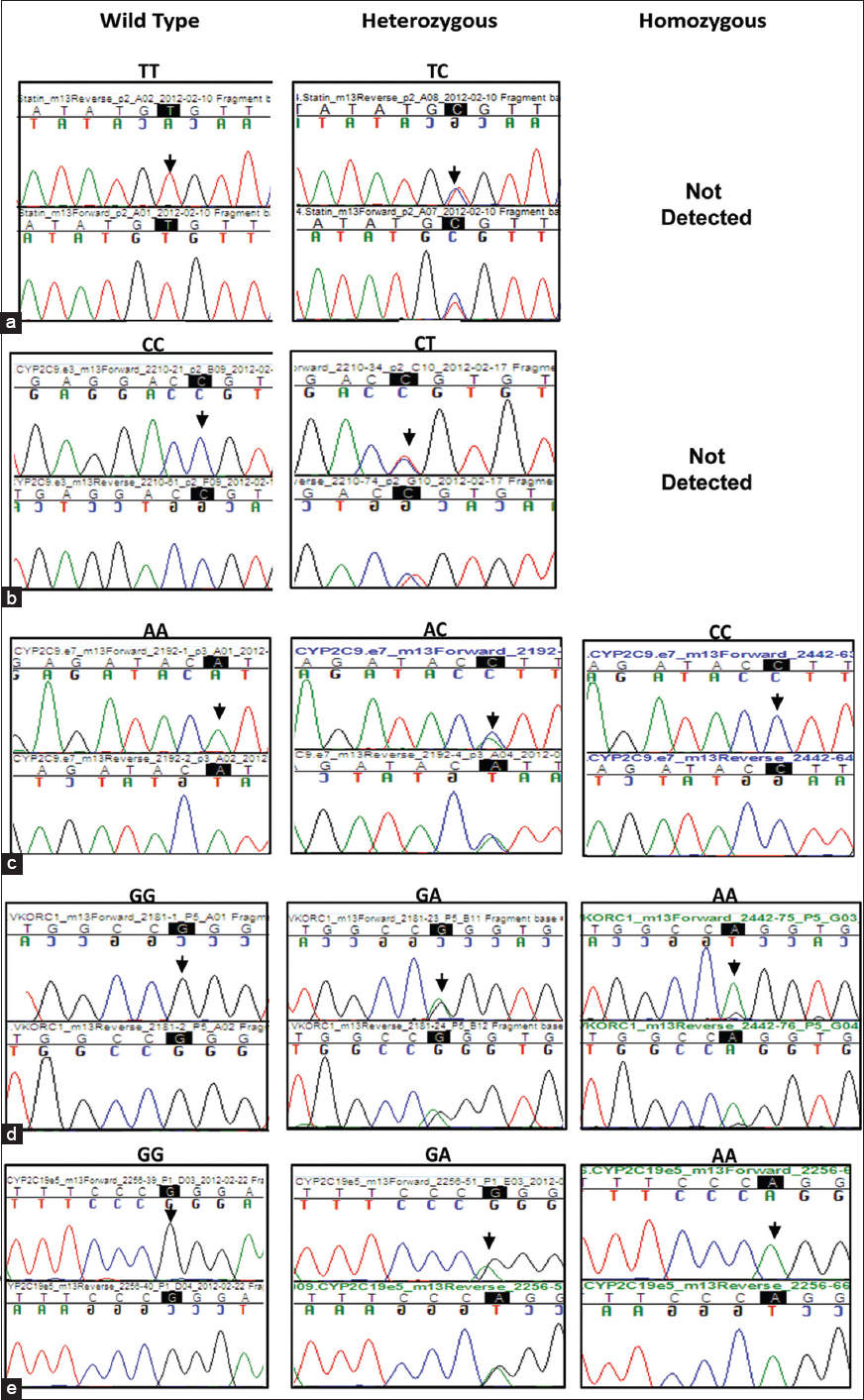 Figure 3: Chromatogram showing the presence of different variants in the genes tested: (a) <i>SLCO1B1</i> (c. 521T > C) (b) <i>CYP2C9</i>*2 (c. 430C > T)c) <i>CYP2C9*</i>3 (c. 1075A > C) (d) <i>VKORC1</i> (c.-1639 G > A)e) <i>CYP2C19*</i>2 (c. 681G > A, exon 5). Chromatogram of the region flanking each variant is highlighted as well as indicated by an arrow over the chromatogram