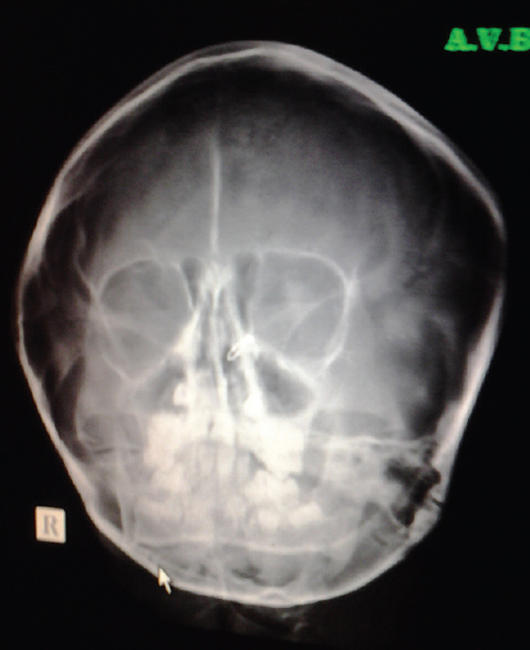 Figure 3: Right frontal sinus hypoplasia