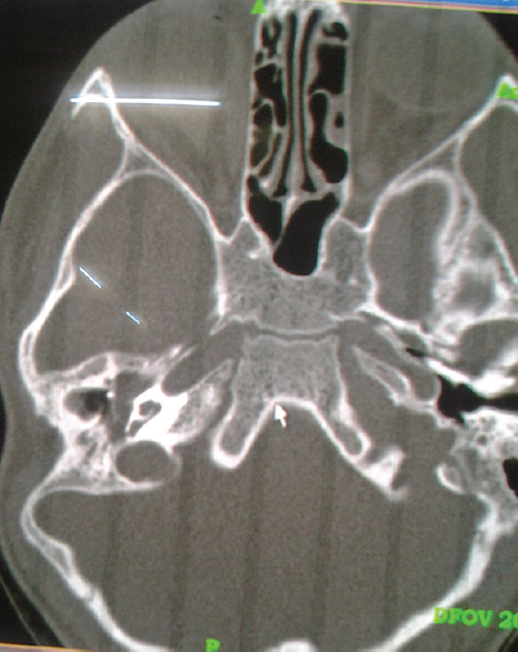 Figure 4: Cholesteatoma