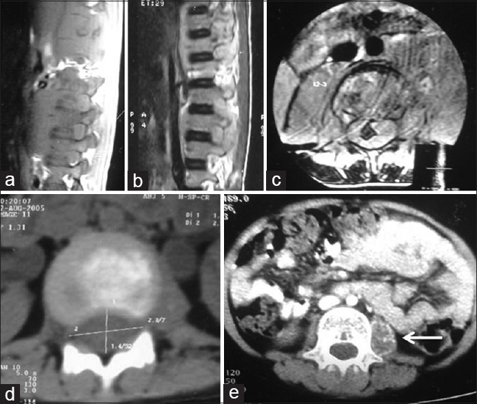 Figure 1: Magnetic resonance imaging images of dorsolumbar spine (axial and sagittal section) shows destruction of vertebrae L1, L2, and L3 with thecal compression (a-c); contrast-enhanced computer tomography scan showing osteolytic lesion involving the lumbar vertebra with cord compression (d), irregular calcification involving the left psoas muscle (arrow) (e)