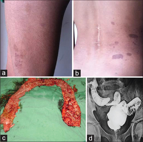 Figure 2: Image showing café au lait spots over the left thigh and back with a scar over the spine showing previous history of surgery (a and b); image of the total proctocolectomy specimen with growth seen at the recto-sigmoid and transverse colon with <100 polyps (c); distal loop ileogram showing the J-pouch ileo-anal anastomosis (d)