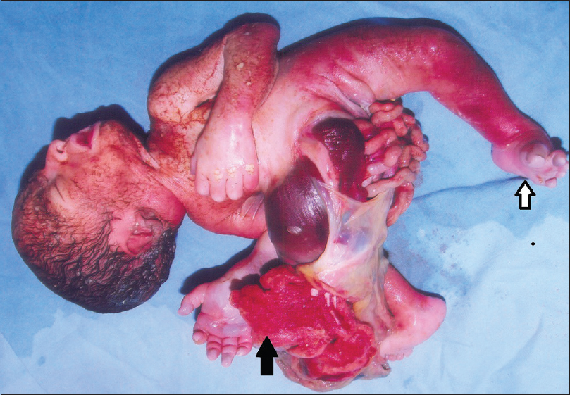 Figure 3: The placenta (dark arrow) directly attached, with no cord and club foot (hollow arrow)