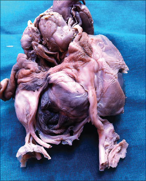 Figure 4: Dissected en block specimen showing exstrophy of the cloaca with opening of the large bowel and small bowel opening (arrow). The vessels are seen laterally which are covered in a sheath (placenta is separated)