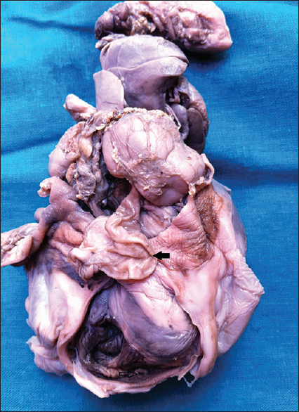 Figure 6: Dissected specimen showing sac like dilatation of right ureter (arrow)