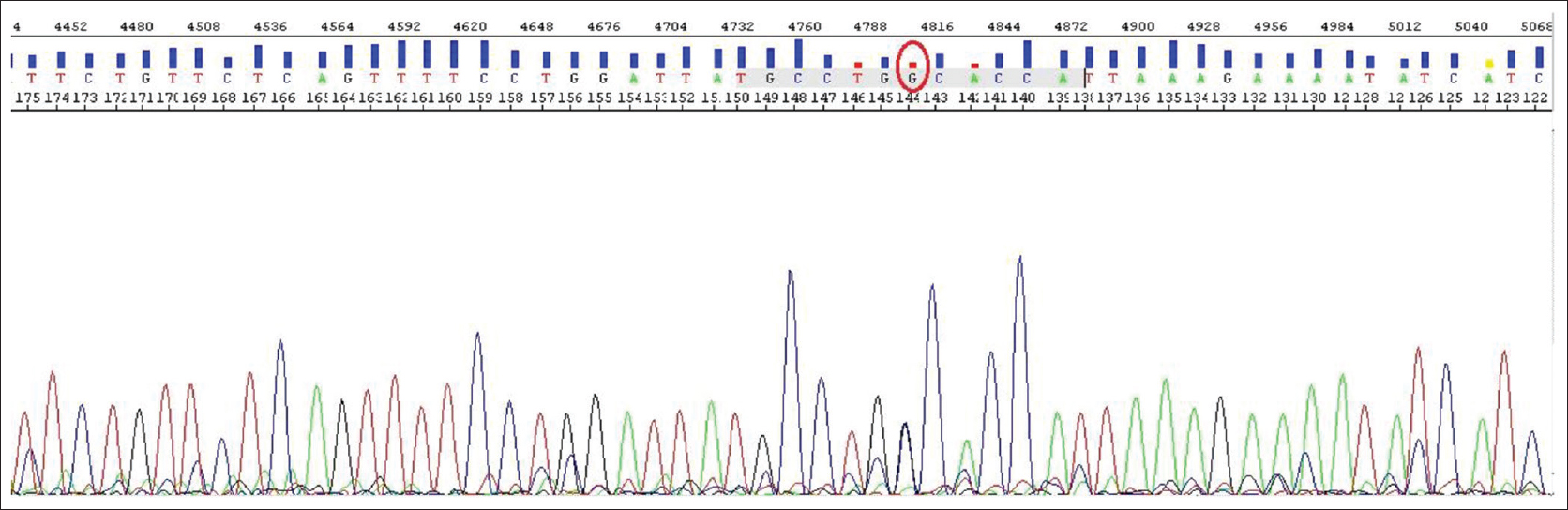 Figure 2: The heterozygote c.1499 mutation (G>C). The sequence resulted from exon 10 sequencing which heterozygote CD500 mutation has created in 1499 place