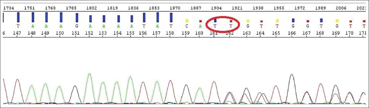 Figure 4: The sequence resulted from sequencing process which ΔF508 mutation is seen as a heterozygote type. In this sequence, disruption in arrangement of the peaks demonstrates that one of the transmitted hereditary genes from parents to the child had been deficit