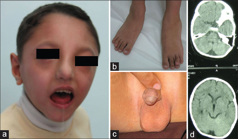 Figure 1: (a) Note to the ptosis, down slanted palpebral fissures, strabismus, and high nasal bridge. (b) Over riding of fourth toes. (c) Hypospadias. (d) Agenesis of the vermis cerebellum