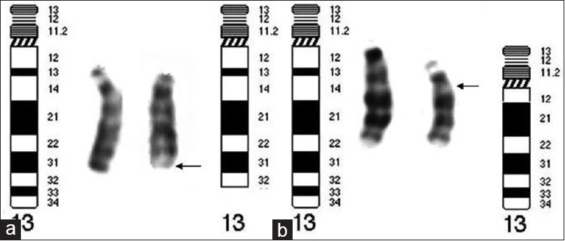 Figure 3: (a) The abnormal chromosome displays deleted region from q33 to q34 which, belongs to Group 3. (b) The abnormal chromosome, with deleted region of q12.3-q14.3 belongs to Group 1