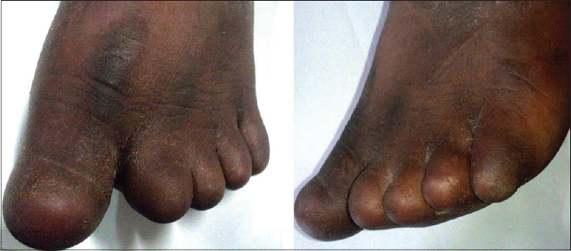 Figure 1: Clinical picture from the front and the sides of the left foot with anonychia, brachydactyly and syndactyly between 2<sup>nd</sup> and <sup>3rd</sup> toe