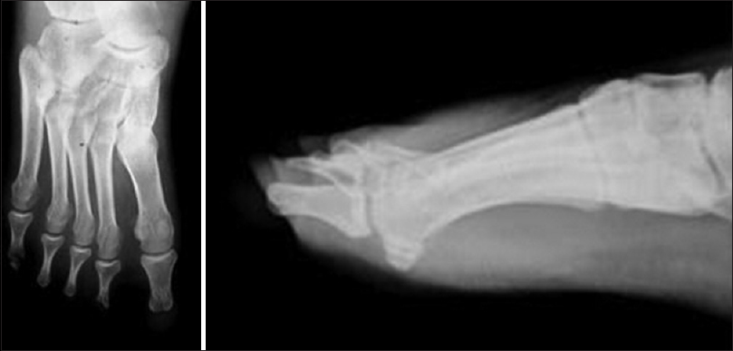 Figure 2: Radiograph anteroposterior and lateral views of left feet showing absence of distal phalanx of all the toes with absence of middle phalanx of toes 1-4, hypoplasia of the middle phalanx of 5<sup>th</sup> toe and normal metatarsals