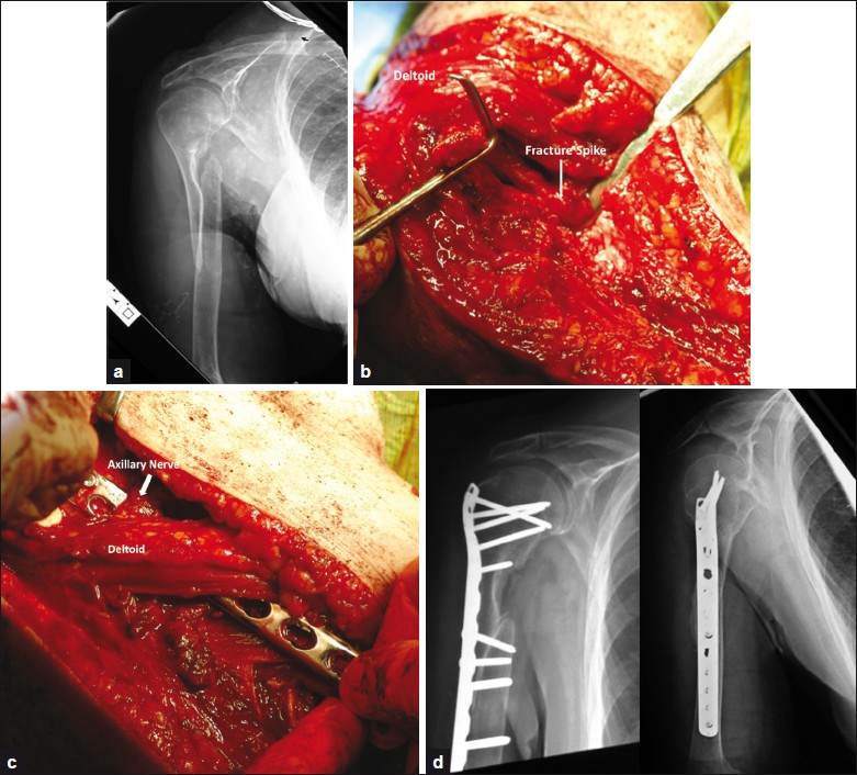 Figure 2: (a) Preoperative radiographs of the patient in case 3; (b) Intraoperative image depicting the lateral surgical approach, with the fracture site identified, prior to debridement; (c) Intraoperative photograph of tunneling the plate under the axillary nerve and the deltoid insertion; (d) Postoperative radiographs