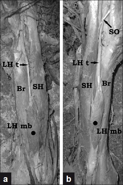 Figure 1: Photographs of the variant findings described on the right (a) and on the left (b) side muscles. (Br - Brachialis; LH mb - Muscular belly of the long head of the biceps brachii; LH t - Proximal tendon of the long head of the biceps brachii; SH - Short head of the biceps brachii; SO - Supernumerary origin of the short head of the biceps brachii)