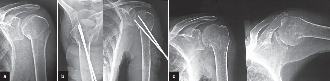 Figure 1: A 61-year-old female presented with two-part fracture showing a final good result. (a) Preoperative X-ray showing two-part fracture with varus angulation (b) Postoperative X-ray showing correction of angulation and fixation by two Schanz screws (c) After removal of Schanz screws