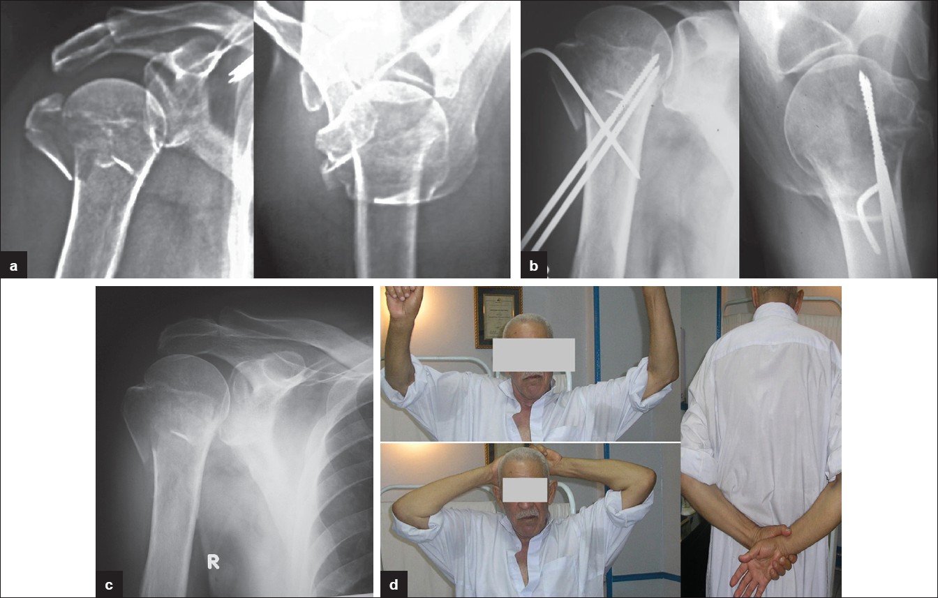 Figure 2: A 74-year-old male presented with three-part fracture showing A final excellent result (a) Preoperative X-ray showing three-part valgus impacted fracture with fragmented greater tuberosity (b) Postoperative X-ray showing disimpaction of the head, correction of the valgus orientation of the head, and reduction of the greater tuberosity beneath the head (c) After removal of Schanz screws (d) Range of shoulder motion