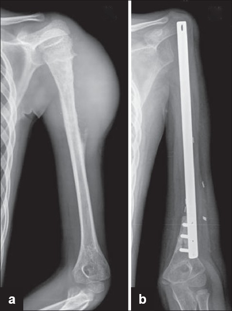 Figure 2: (a) Radiograph showing Ewing's sarcoma of the proximal humerus (b) Radiograph showing reconstruction with the customised plate