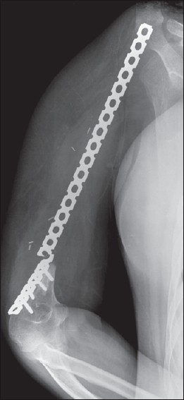 Figure 3: Plate breakage (case: 1) at 13 months when a conventional reconstruction plate was used