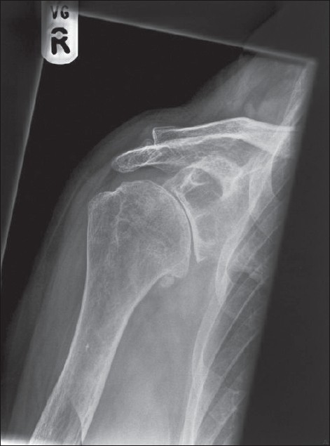 Figure 1: Preoperative radiograph demonstrating severe osteoarthritis
