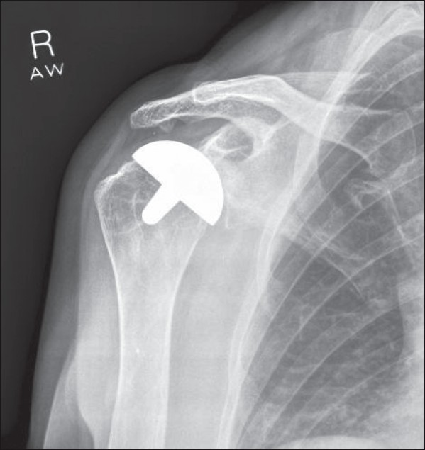 Figure 3: Radiograph at 1 year showing new bony spur on the inferior surface of the acromion