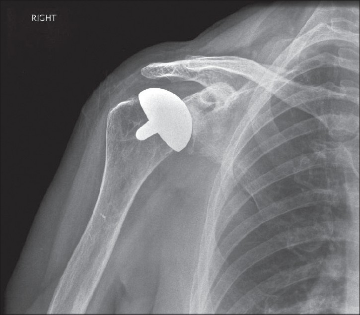 Figure 4: Appearance following arthroscopic resection of the spur