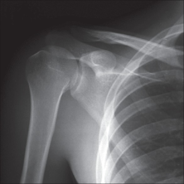 Figure 1: Anteroposterior radiograph of the shoulder evokes suspicion of a fracture of the lesser tuberosity