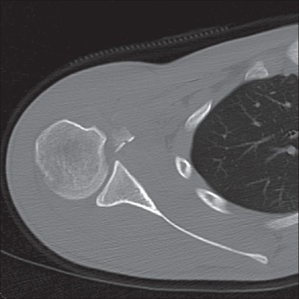 Figure 2: Preoperative CT. Axial view shows the fractured lesser tuberosity and a defect on the humeral head