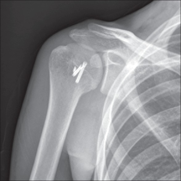 Figure 3: Anteroposterior radiograph after the fixation of the lesser tuberosity with two headless fully threaded bone screws
