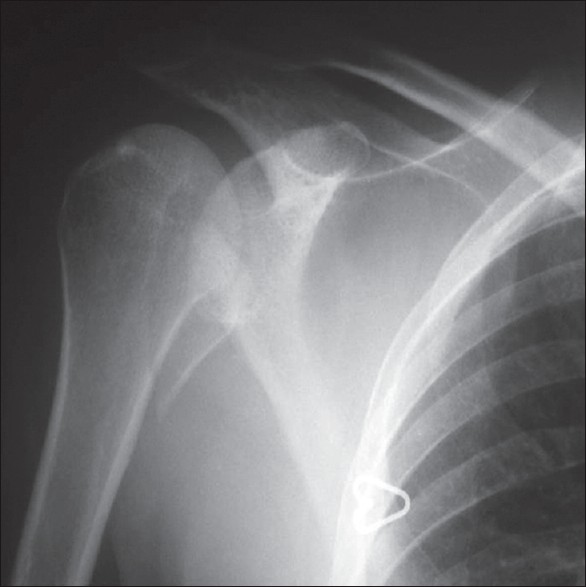 Figure 4: Anteroposterior radiograph showing an isolated lesser tuberosity fracture