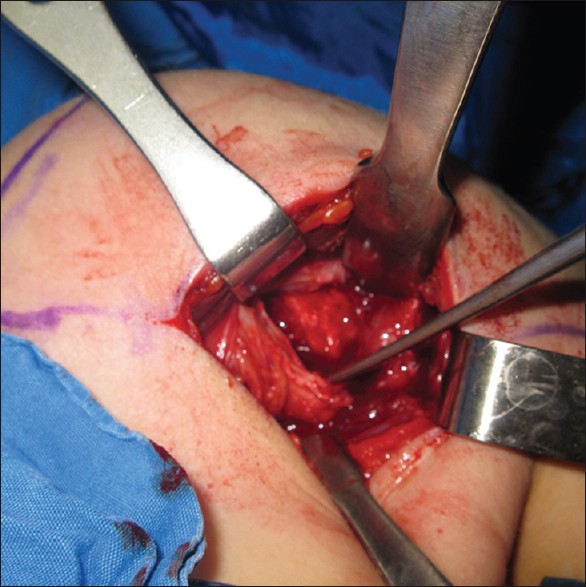 Figure 5: Intraoperative view of the fractured lesser tuberosity. Fragment is elevated