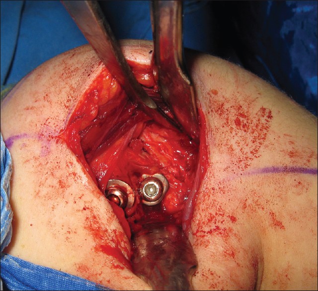 Figure 6: After the surgical fixation of the lesser tuberosity