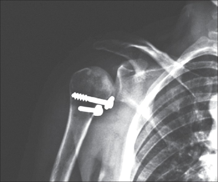 Figure 7: Postoperative anteroposterior radiograph shows the reduction of the fragment to its anatomical location