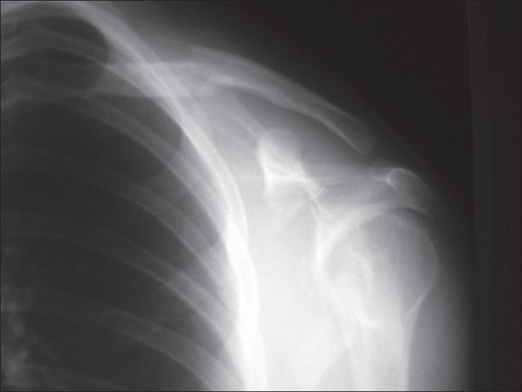 Figure 1: Craig type I fracture of clavicle (middle third), fracture of scapula (probably Ideberg type V), floating shoulder