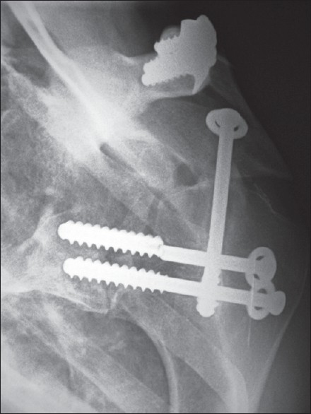 Figure 10: X-ray. After a new trauma, one screw seems to be broken. However, fibrous union with no secondary displacement can be seen