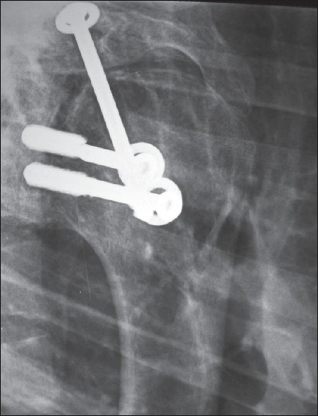 Figure 11: X-ray. Another actual projection. Transthoracic view. Glenohumeral fibrous union