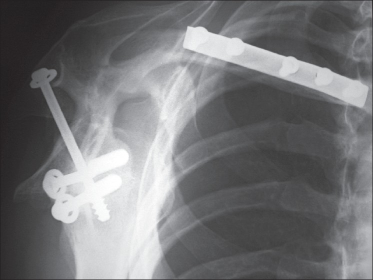 Figure 12 : X-ray. Outlet view