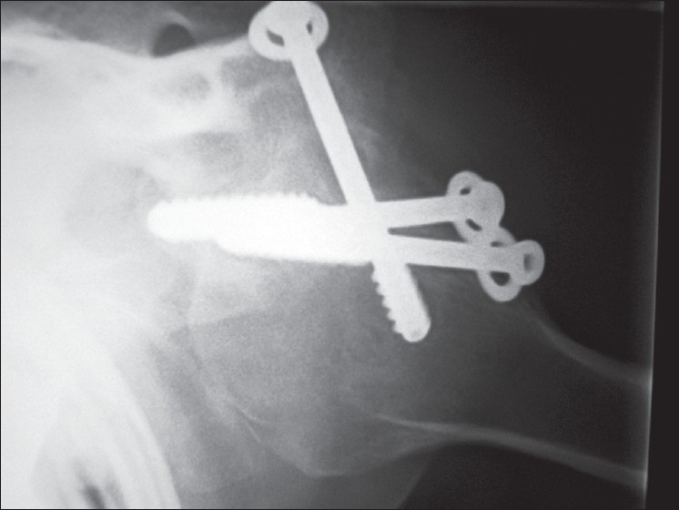 Figure 13: X-ray. Axial view