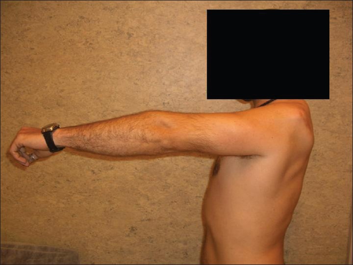 Figure 14: Fourteen years and 8 months later. We can observe the same movement arc from 1 year ago. Although one screw broke, anterior flexion was until 90°. We can observe deltoid atrophy