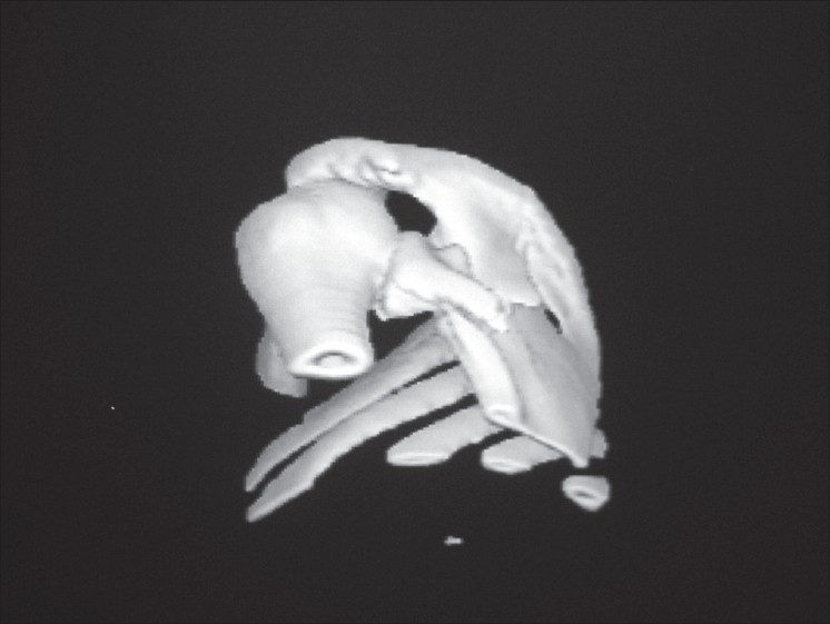 Figure 3: Three-dimensional CT reconstruction. Original image from 1996. Comminuted fracture of scapula, probably Ideberg type V