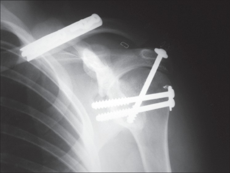 Figure 4: Radiographic image of arthrodesis of the shoulder with three cannulated screws. Observe the staples which close arthroscopic portals, without requiring larger incisions. Glenohumeral and acromiohumeral stability is ascertained by the degree of compression that is achieved. Clavicle osteosynthesis is also noteworthy; this had been performed 7 months previously, using an osteosynthesis plate (1996)