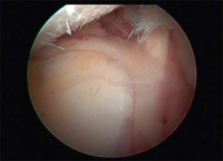 Figure 5: Glenohumeral joint viewed from standard arthroscopic portal