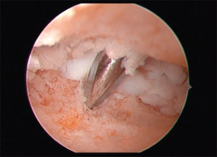 Figure 6: After we denuded articular surfaces of both humeral head and glenoid to bleeding subchondral bone, we used two guidewires through the proximal humerus from lateral to medial and into the joint under direct arthroscopic visualization. We can see one of them. Both guidewires were driven through the center of the glenoid