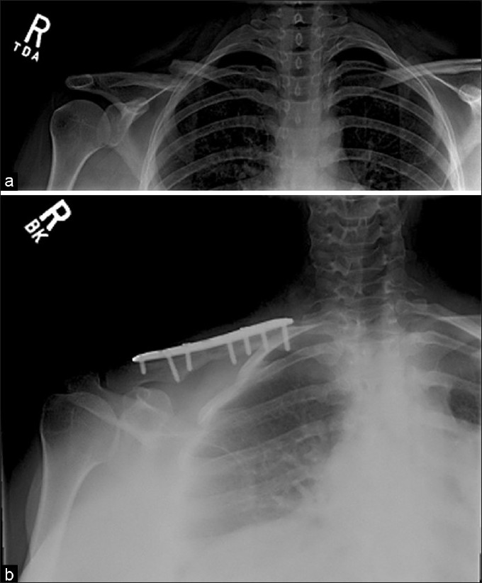 Figure 1: Clavicle nonunion (a). Union demonstrated after fixation (b); patient had radiographic and clinical evidence of union after fixation