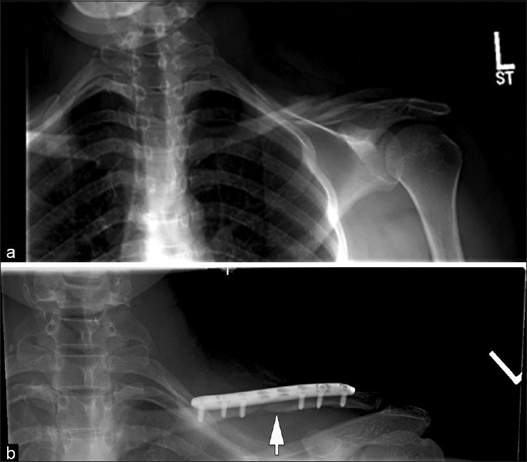 Figure 2: Clavicle nonunion (a). No radiographic evidence of complete union (b) despite full strength, range of motion and no pain on clinical exam. Fracture line still visible eight months postoperatively (arrow)