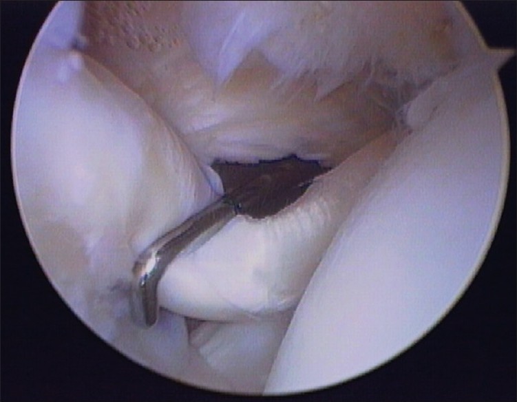 Figure 1: Arthroscopic photograph of a Lafosse grade 0 proximal biceps tendon injury