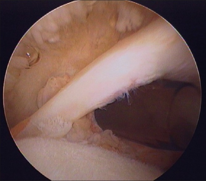 Figure 2: Arthroscopic photograph of a Lafosse grade 1 proximal biceps tendon injury