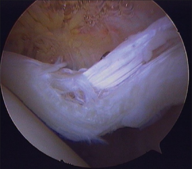 Figure 3: Arthroscopic photograph of a Lafosse grade 2 proximal biceps tendon injury